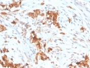 IHC staining of FFPE human mesothelioma with Mesothelin antibody (clone MSLN/3385). HIER: boil tissue sections in pH 9 10mM Tris with 1mM EDTA for 20 min and allow to cool before testing.