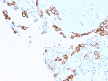 IHC staining of FFPE human mesothelioma with MSLN antibody. HIER: boil tissue sections in pH 9 10mM Tris with 1mM EDTA for 20 min and allow to cool before testing.