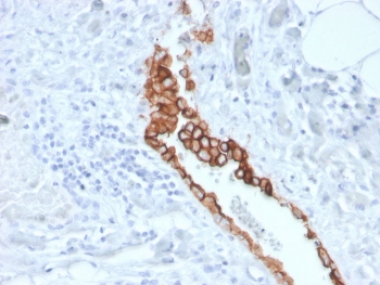 IHC staining of FFPE human mesothelioma with MSLN antibody. HIER: boil tissue sections in pH 9 10mM Tris with 1mM EDTA for 20 min and allow to cool before testing.