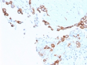 IHC staining of FFPE human mesothelioma with MSLN antibody (clone MSLN/3387). HIER: boil tissue sections in pH 9 10mM Tris with 1mM EDTA for 20 min and allow to cool before testing.