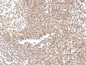 IHC staining of FFPE human colon with p16INK4a antibody (clone CDKN2A/3830). HIER: boil tissue sections in pH 9 10mM Tris with 1mM EDTA for 20 min and allow to cool before testing.