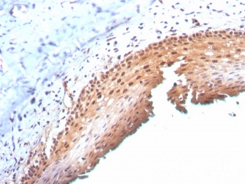 IHC staining of FFPE human cervix with p16INK4a antibody (clone CDKN2A/3830). HIER: boil tissue sections in pH 9 10mM Tris with 1mM EDTA for 20 min and allow to cool before testing.~