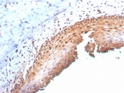 IHC staining of FFPE human cervix with p16INK4a antibody (clone CDKN2A/3830). HIER: boil tissue sections in pH 9 10mM Tris with 1mM EDTA for 20 min and allow to cool before testing.