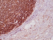 IHC staining of FFPE human seminoma tissue with recombinant Podoplanin antibody (clone PDPN/4009R). HIER: boil tissue sections in pH 9 10mM Tris with 1mM EDTA for 20 min and allow to cool before testing.
