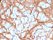 IHC staining of FFPE human colon carcinoma with Periostin antibody (clone POSTN/3503). HIER: boil tissue sections in pH 9 10mM Tris with 1mM EDTA for 20 min and allow to cool before testing.