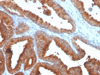 IHC staining of FFPE human prostate carcinoma with recombinant Prostate Specific Antigen antibody (clone rKLK3/4753). HIER: boil tissue sections in pH 9 10mM Tris with 1mM EDTA for 20 min and allow to cool before testing.~