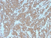 IHC staining of FFPE human colon carcinoma with IL1A antibody (clone IL1A/3981). HIER: boil tissue sections in pH 9 10mM Tris with 1mM EDTA for 20 min and allow to cool before testing.