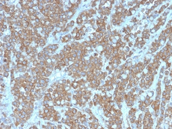 IHC staining of FFPE human colon carcinoma with IL1A antibody. HIER: boil tissue sections in pH 9 10mM Tris with 1mM EDTA for 20 min and allow to cool before testing.