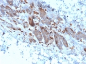 IHC staining of FFPE human colon carcinoma with IL-1 alpha antibody (clone IL1A/3982). HIER: boil tissue sections in pH 9 10mM Tris with 1mM EDTA for 20 min and allow to cool before testing.