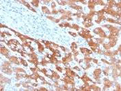 IHC staining of FFPE human liver carcinoma with Retinol Binding Protein 4 antibody (clone RBP4/4041). HIER: boil tissue sections in pH 9 10mM Tris with 1mM EDTA for 20 min and allow to cool before testing.