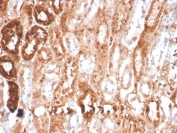 IHC staining of FFPE human renal cell carcinoma with Retinol Binding Protein 4 antibody (clone RBP4/4041). HIER: boil tissue sections in pH 9 10mM Tris with 1mM EDTA for 20 min and allow to cool before testing.