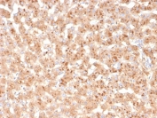 IHC staining of FFPE human liver with TTR antibody. HIER: boil tissue sections in pH 9 10mM Tris with 1mM EDTA for 20 min and allow to cool before testing.