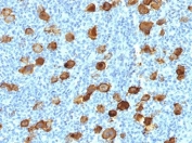 IHC testing of FFPE Hodgkin's lymphoma stained with recombinant CD30 antibody (clone Ki-1/4399R). Required HIER: steam sections in pH9, 1mM EDTA for 10-20 min.