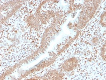 IHC staining of FFPE human colon carcinoma with recombinant PMS2 antibody. HIER: boil tissue sections in pH 9 10mM Tris with 1mM EDTA for 20 min and allow to cool before testing.