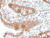 IHC staining of FFPE human colon carcinoma with recombinant PMS2 antibody (clone PMS2/4373R). HIER: boil tissue sections in pH 9 10mM Tris with 1mM EDTA for 20 min and allow to cool before testing.