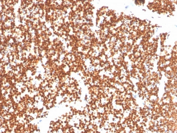 IHC staining of FFPE human thymus with NR5A1 antibody. HIER: boil tissue sections in pH 9 10mM Tris with 1mM EDTA for 20 min and allow to cool before testing.