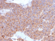 IHC staining of FFPE human liver carcinoma with B7-H6 antibody. HIER: boil tissue sections in pH 9 10mM Tris with 1mM EDTA for 20 min and allow to cool before testing.