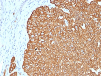 IHC staining of FFPE human basal cell carcinoma with recombinant Cytokeratin 5 antibody (clone KRT5/4245R). HIER: boil tissue sections in pH 9 10mM Tris with 1mM EDTA for 20 min and allow to cool before testing.~