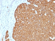 IHC staining of FFPE human basal cell carcinoma with recombinant Cytokeratin 5 antibody (clone KRT5/4245R). HIER: boil tissue sections in pH 9 10mM Tris with 1mM EDTA for 20 min and allow to cool before testing.