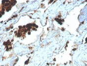 IHC staining of FFPE human lung adenocarcinoma with recombinant Napsin A antibody (clone NAPSA/4400R). HIER: boil tissue sections in pH 9 10mM Tris with 1mM EDTA for 20 min and allow to cool before testing.