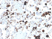 IHC staining of FFPE human lung adenocarcinoma with Napsin A antibody (clone NAPSA/3305). HIER: boil tissue sections in pH 9 10mM Tris with 1mM EDTA for 20 min and allow to cool before testing.