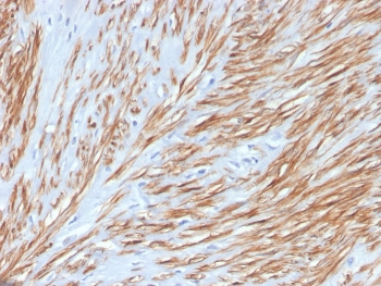 IHC staining of FFPE human leiomyosarcoma with recombinant CNN1 antibody. HIER: boil tissue sections in pH 9 10mM Tris with 1mM EDTA for 20 min and allow to cool before testing.~