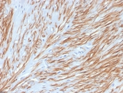 IHC staining of FFPE human leiomyosarcoma with recombinant CNN1 antibody. HIER: boil tissue sections in pH 9 10mM Tris with 1mM EDTA for 20 min and allow to cool before testing.