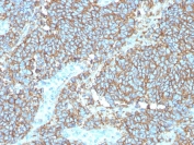 IHC staining of FFPE human Ewings sarcoma with recombinant CD99 antibody (clone rMIC2/3317). HIER: boil tissue sections in pH 9 10mM Tris with 1mM EDTA for 20 min and allow to cool before testing.