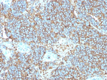 IHC staining of FFPE human Ewings sarcoma with recombinant CD99 antibody (clone rMIC2/3317). HIER: boil tissue sections in pH 9 10mM Tris with 1mM EDTA for 20 min and allow to cool before testing.~