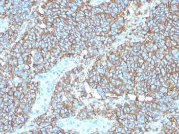 IHC staining of FFPE human Ewings sarco