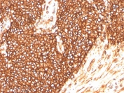 IHC staining of FFPE human Ewings sarcoma with recombinant CD99 antibody (clone MIC2/3478R). HIER: boil tissue sections in pH 9 10mM Tris with 1mM EDTA for 20 min and allow to cool before testing.