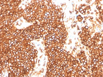 IHC staining of FFPE human Ewings sarcoma with recombinant CD99 antibody (clone MIC2/3478R). HIER: boil tissue sections in pH 9 10mM Tris with 1mM EDTA for 20 min and allow to cool before testing.~