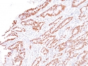 IHC staining of FFPE human colon carcinoma with MLH1 antibody (clone G168-728). HIER: boil tissue sections in pH 9 10mM Tris with 1mM EDTA for 20 min and allow to cool before testing.