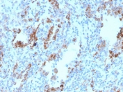 IHC staining of FFPE human lymph node with TIM-3 antibody. HIER: boil tissue sections in pH 9 10mM Tris with 1mM EDTA for 20 min and allow to cool before testing.