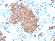 IHC staining of FFPE human lung carcinoma with CD86 antibody (clone C86/3711). HIER: boil tissue sections in pH 9 10mM Tris with 1mM EDTA for 20 min and allow to cool before testing.