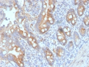 IHC staining of FFPE human colon carcinoma with CD33 antibody (clone SIGLEC3/3600). HIER: boil tissue sections in pH 9 10mM Tris with 1mM EDTA for 20 min and allow to cool before testing.