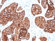 IHC staining of FFPE human squamous cell carcinoma with Cytokeratin 5/6 antibody (clone KRT5.6/4866). HIER: boil tissue sections in pH 9 10mM Tris with 1mM EDTA for 20 min and allow to cool before testing.