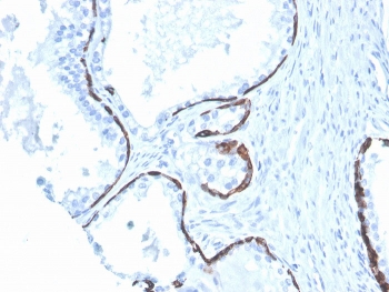 IHC staining of FFPE human prostate with Cytokeratin 5/6 antibody (clone KRT5.6/4866). HIER: boil tissue sections in pH 9 10mM Tris with 1mM EDTA for 20 min and allow to cool before testing.~