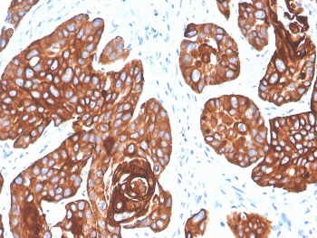 IHC staining of FFPE human squamous cell carc