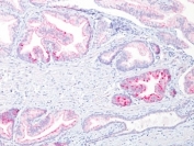 Formalin-fixed, paraffin-embedded human prostate carcinoma stained with p504S antibody (clone 13H4).