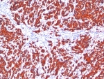 IHC staining of FFPE human breast carcinoma tissue with Pan Cytokeratin antibody cocktail (clone SPM115 + SPM116). HIER: boil tissue sections in pH 9 10mM Tris with 1mM EDTA for 20 min and allow to cool before testing.