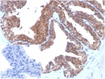 IHC staining of FFPE human prostate tissue with Macrophage migration inhibitory factor antibody (clone MIF/3488). Negative control inset: PBS instead of primary antibody to control for secondary binding. HIER: boil tissue sections in pH 9 10mM Tris with 1mM EDTA for 20 min and allow to cool before testing.