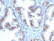 IHC staining of FFPE human prostate tissue with NKX3.1 antibody (clone rNKX3.1/6620). HIER: boil tissue sections in pH 9 10mM Tris with 1mM EDTA for 20 min and allow to cool before testing.