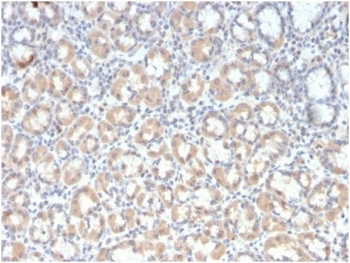 IHC staining of FFPE human gastric carcinoma tissue with recombinant Mucin-3 antibody (clone rMUC3/1154). HIER: boil tissue sections in pH 9 10mM Tris with 1mM EDTA for 20 min and allow to cool before testing.~