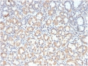 IHC staining of FFPE human gastric carcinoma tissue with recombinant Mucin-3 antibody (clone rMUC3/1154). HIER: boil tissue sections in pH 9 10mM Tris with 1mM EDTA for 20 min and allow to cool before testing.