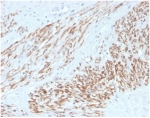 IHC staining of FFPE human leiomyosarcoma tissue with recombinant MYH11 antibody (clone MYH11/4337R). HIER: boil tissue sections in pH 9 10mM Tris with 1mM EDTA for 20 min and allow to cool before testing.