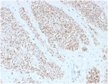 IHC staining of FFPE human leiomyosarcoma with recombinant MYH11 antibody (clone MYH11/4337R). HIER: boil tissue sections in pH 9 10mM Tris with 1mM EDTA for 20 min and allow to cool before testing.~