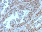 IHC staining of FFPE human colon tissue with PAX2 antibody (clone PAX2/1105). HIER: boil tissue sections in pH 9 10mM Tris with 1mM EDTA for 20 min and allow to cool before testing.