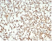 IHC staining of FFPE human renal cell carcinoma tissue with PAX2 antibody (clone PAX2/1105). HIER: boil tissue sections in pH 9 10mM Tris with 1mM EDTA for 20 min and allow to cool before testing.