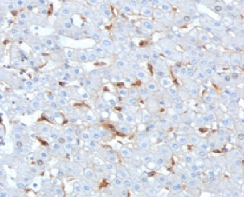IHC staining of FFPE human hepatocellular carcinoma tissue with Complement C1q B-Chain antibody (clone C1QB/2962). HIER: boil tissue sections in pH 9 10mM Tris with 1mM EDTA for 20 min and allow to cool before testing.~